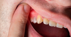 Abscessed Tooth - Emergency Dental of Grand Rapids