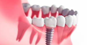 Implants - Emergency Dental of Grand Rapids