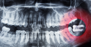 wisdom teeth - Emergency Dental of Grand Rapids